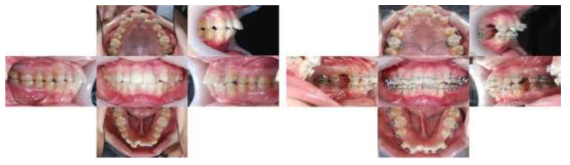 교정기 장착 전(왼쪽)과 발치 및 교정기 장착 후(오른쪽)의 구강 내부사진
