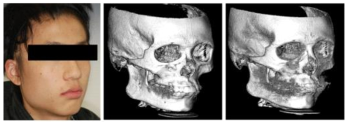 실제 환자의 사진(오른쪽), 교정기 장착 전(중앙)과 발치 및 교정기 장착 후(오른쪽, 교정와이어를 확인할 수 있음)의 악안면 CT 데이터로부터 Vworks 프로그램을 이용하여 3D로 재구성한 예