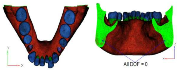 부정교합 class II 환자의 하악 FEA 모델에 있어 치아이동의 정량적 해석하기 위해서 설정한 구속조건