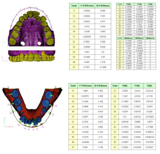 부정교합 class II 환자의 상악(위쪽)과 하악(아래쪽) FEA 모델에서 브라켓과 치아가 이동해야할 거리와 와이어의 반력 결과