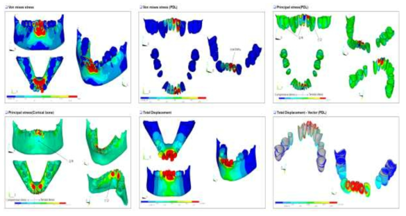 부정교합 class II 환자의 하악 FEA 모델에서 Von mises stress, principal stress와 전체 변위의 결과