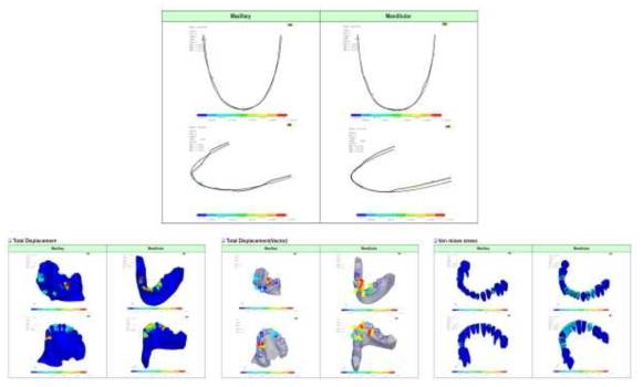 부정교합 class I 환자의 FEA 상악과 하악 모델에서 와이어의 반력, Von mises stress와 전체 변위의 결과