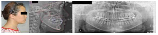 부정교합 class III 환자(SHW)의 초기 교정적 검사