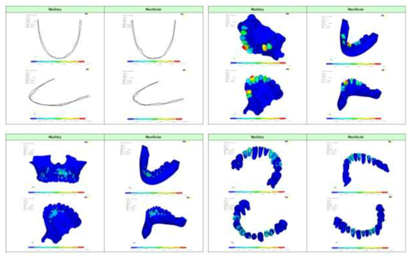 부정교합 class III 환자의 FEA 모델에서 와이어의 반력, Von mises stress와 전체 변위의 결과