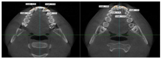 교정치료 전 환자의 CT 사진으로부터 Vworks 프로그램을 이용해 2D 이미지로 재구성후 환자 영상 분획 중 실제 치아 배열과 가장 유사한 영상을 선택한 후 치아사이의 거리를 측정
