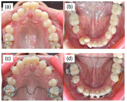 초기 교정단계에서의 intraoral 사진. 초기 교정치료전의 (a) 상악과 (b) 하악, 초기 교정치료 후의 (c)상악과 (d) 하악