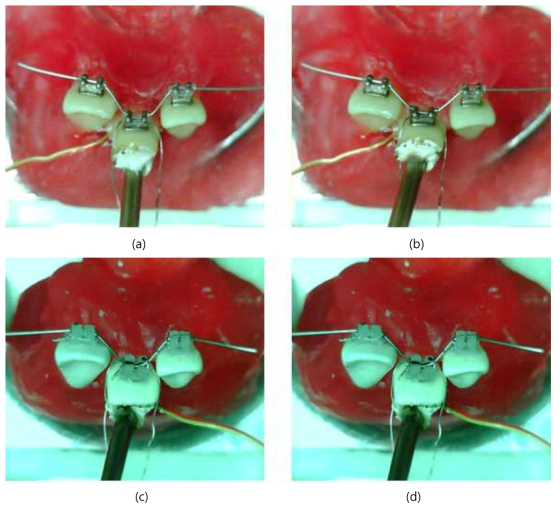 Mini-Taurus® 일반결찰 브라켓 그룹의 치료 전(a)과 후(b)의 결과와 Clarity® 일반결찰 브라켓 그룹의 치료 전(c)과 후(d)의 사진