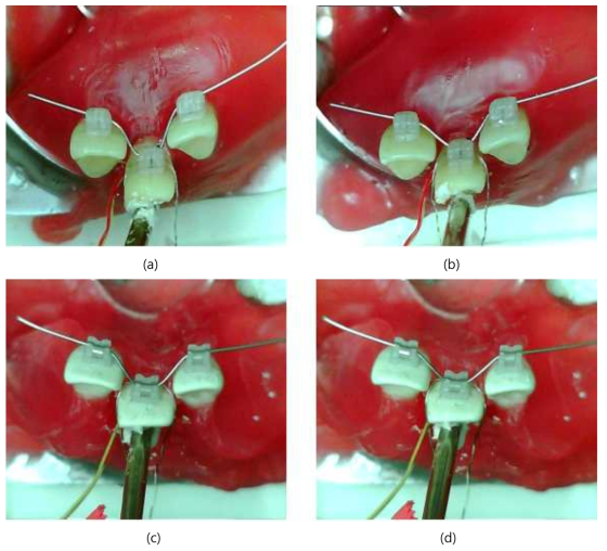 Mini-Taurus® 일반결찰 브라켓 그룹의 치료 전(a)과 후(b)의 결과와 Clarity® 일반결찰 브라켓 그룹의 치료 전(c)과 후(d)의 사진