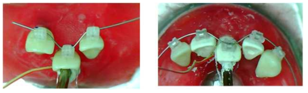 (좌)3개의 연속된 치아와 (우)5개의 연속된 치아에서 초기조건(4mm 이동해야할 경우) 각 브라켓의 구속조건(ligation과 브라켓 재료)에 따른 교정력 측정