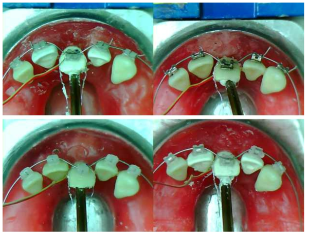 일반결찰 브라켓과 자가결찰 브라켓을 이용하여 제작한 5개 치아모델