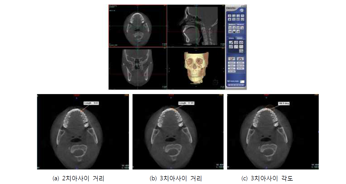 vWorks에서 환자 CT로부터 2개와 3개 치아사이의 거리와 각도 측정