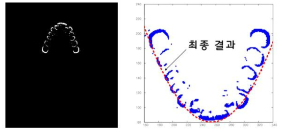 Otsu 알고리즘에 의하여 자동 추출된 치아의 경계정보 (좌)와 최종적으로 얻어진 치아외곽 정보와 치료 후의 예상 와이어 결과(우)