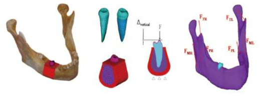 (좌) 해석을 위하여 제작한 3D 유한요소모델과 해당 segment 부분에서 하나의 독립된 치아와 PDL, cortical 부분 (적색)과 치밀골 부분(보라색), (우) loading과 경계조건 설정 부분