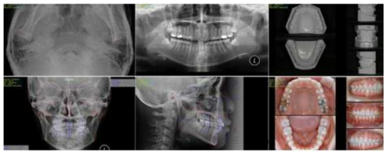 교정치료를 위한 파노라마, 세팔로 촬영, 구강내 사진, 진단모형을 위한 본뜨기와 같은 정밀진단의 예