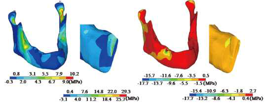 하악골 모델에서 principal stress의 contour 결과 (좌) tensile stress, (우) compressive stress