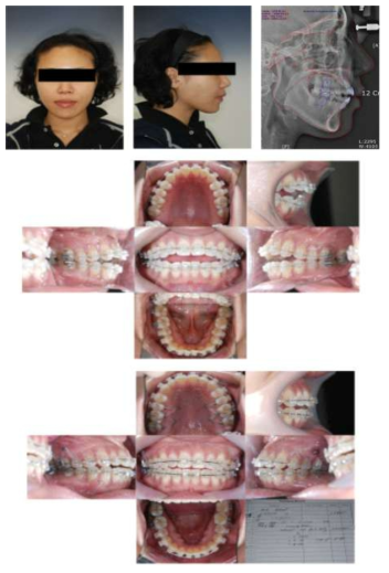 부정교합 class I로 사용된 환자 데이터의 예 (중) 2010.01.13 촬영, (하) 2010.09.02촬영