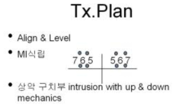 부정교합 class I에 사용된 치료계획