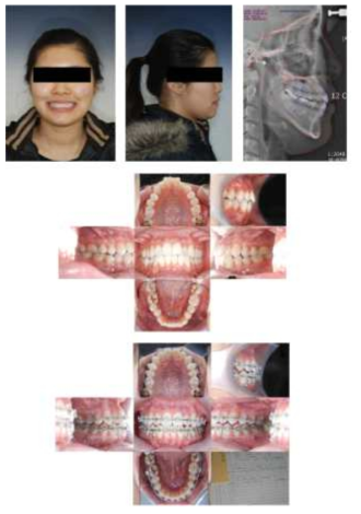 부정교합 class III로 사용된 환자 데이터의 예 2010년 4월23일 (중)과 9월 2일 (중) 촬영