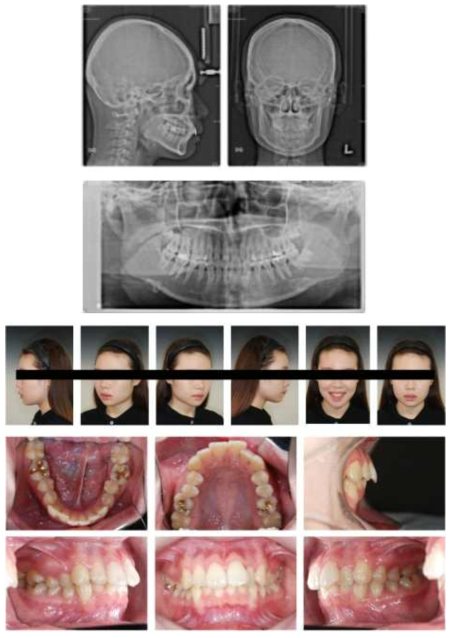 부정교합 Class II의 진단을 받은 환자의 임상 사진