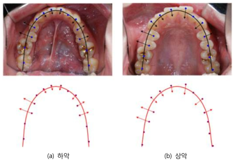 최적화 알고리즘을 적용하여 사진으로부터 계산된 교정치료 시 치아의 이동 방향