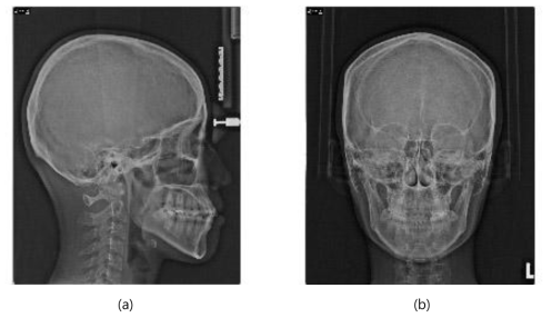 측모두부방사선사진(a)과 정모두부 방사선사진(b)