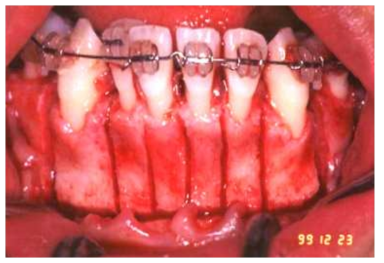 Corticotomy를 시행한 직후