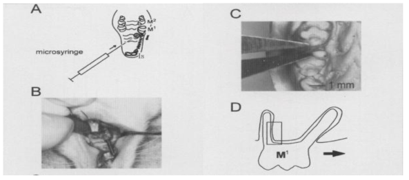 Orthodontic tooth movement.