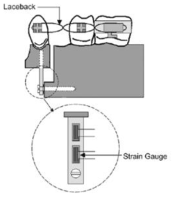 영국의 Khambay와 아일랜드의 Milett 공동연구로 2개의 strain gauge를 이용하여 교정력 측정을 시도함