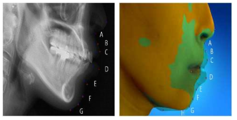 A: Subnasale, B: Soft tissue A, C: Labiale superius, D: Labiale inferius, E: Soft tissue B, F: Soft tissue pogonion, G: Soft tissue gnathion, H: Soft tissue menton.