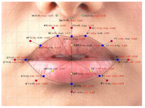 소구치 발치 교정치료 후 입술주위 연조직의 3차원적 변화 단위: mm (x축 변화량, y축 변화량, z축 변화량)