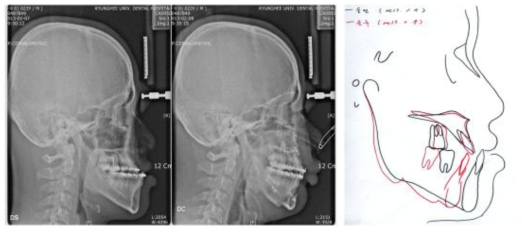 악교정 수술 전후의 측모두부방사선사진의 2차원적 중첩
