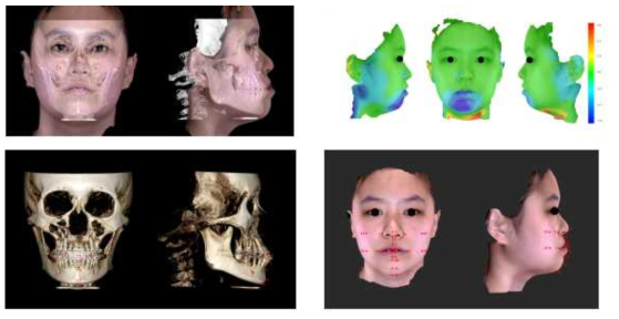악교정 수술 전후의 경조직과 연조직의 3차원적인 중첩