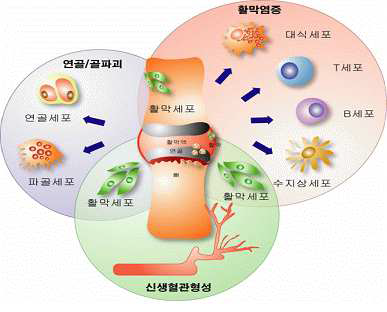 자가 면역 관절염의 주요 병인 기전