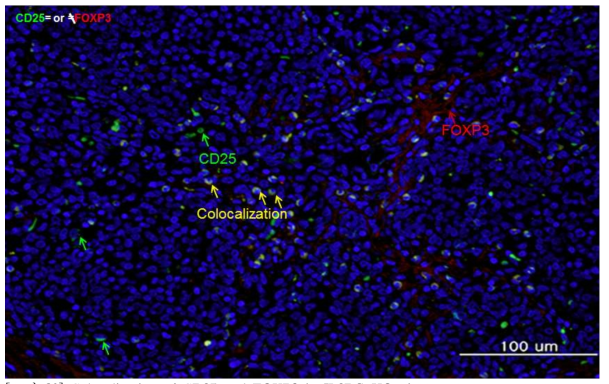 Colocalization of CD25 and FOXP3 in IL2RG KO pigs