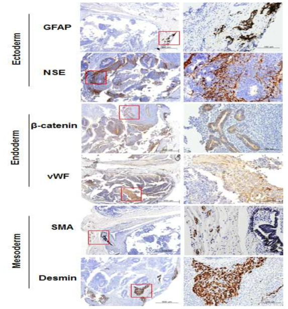 IL2RG -/- KO 마우스에서 teratoma 형성. a) IL2RG에 형성된 teratoma b) PCR을 이용하여 human specific mitochondrial mitofusin (MFN1)으로 확인, PCR 크기는 236bp. P: genomic DNA from human iPSC.