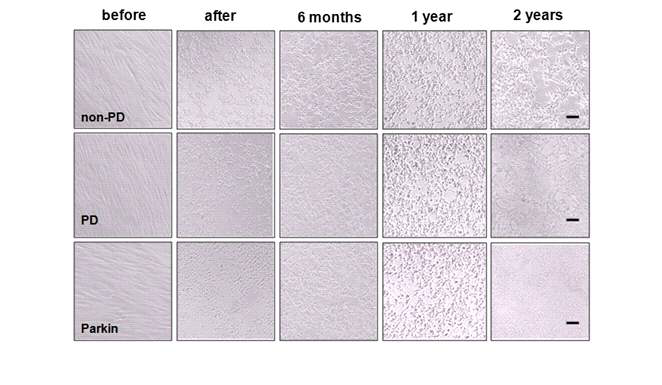 파킨슨환자 및 뇌하수체 선종환자의 지방유래 간엽줄기세포의 hTERT plasmid를 이용한 세포불멸화 (before, after, 6months, 1 year, 2 years).