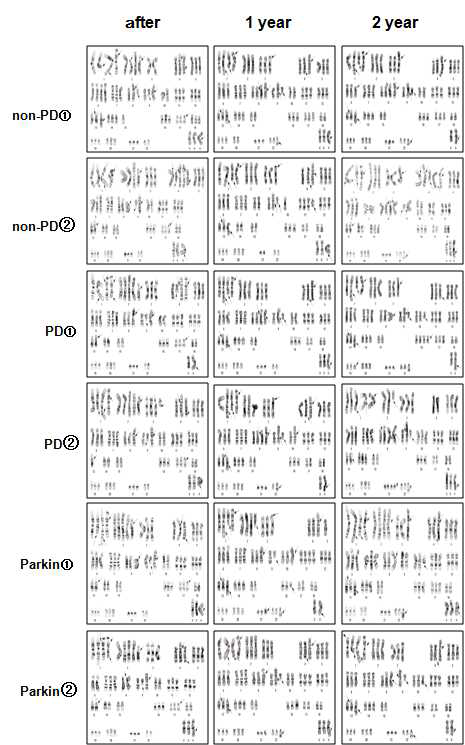 불멸화된 파킨슨환자 및 뇌하수 체 선종환자의 지방유래 간엽줄기세포의 염색체 Karyotyping 분석