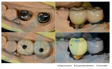 나사유지형 임플란트 상부구조물 (A: 상부구조물, B: 지대주, C: 스크루 구멍)