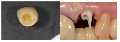 티타늄 링커와 맞춤형 지르코니아 코어를 이용한 전치부 심미 증례에서 지르코니아 지대주의 파절로 인해 실패한 경우