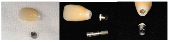 티타늄 Implant abutment의 단점