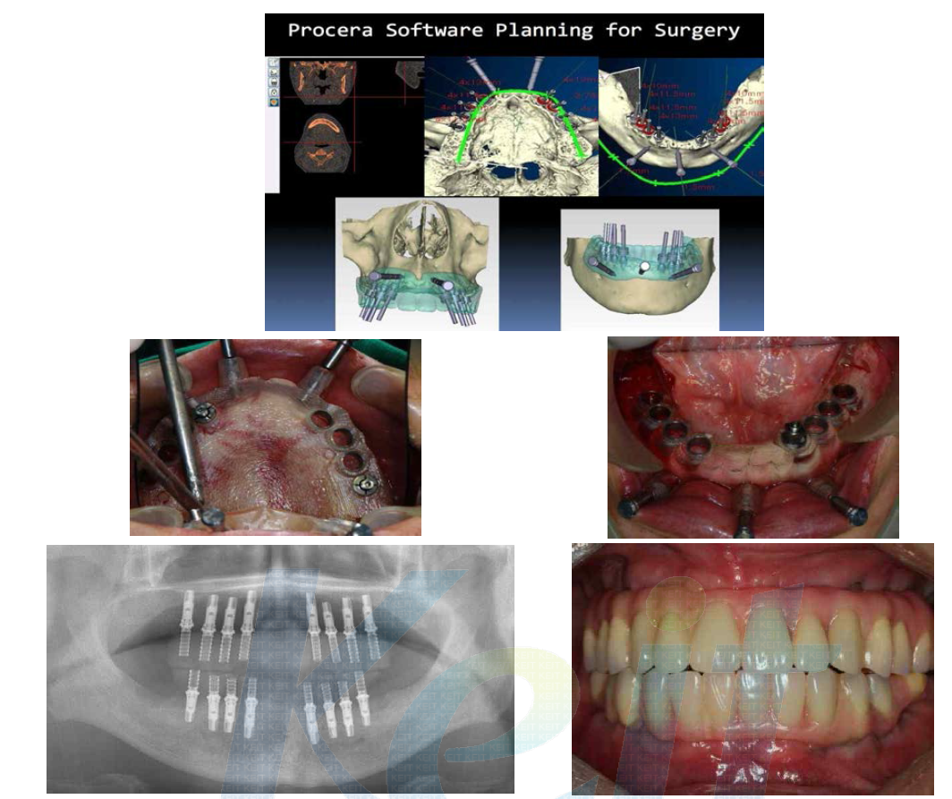 수술 템플릿을 미리 제작하여 수술 당일 임플란트 16개를 식립하고 임시 보철물까지 완성한 케이스