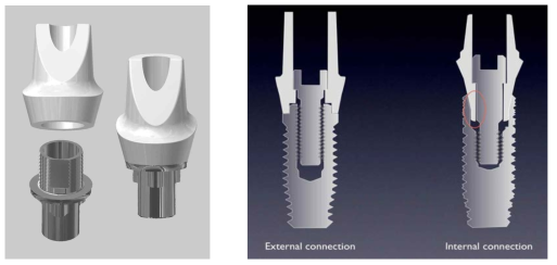 임플란트 내부, 외부 연결형 구조