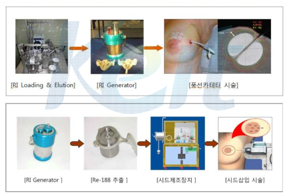 근접치료 방사성동위원소 시술 개념도