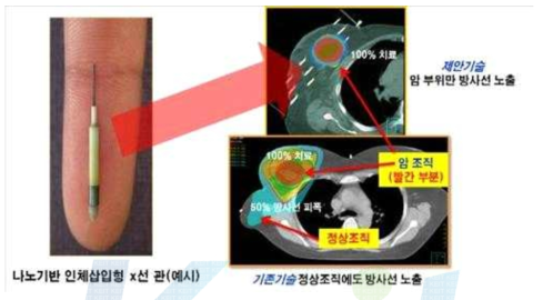 탄소나노튜브 엑스선 유방암 근접치료 기술