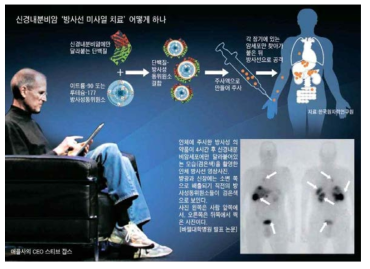 신경내분비암 방사선미사일 치료기술 설명그림