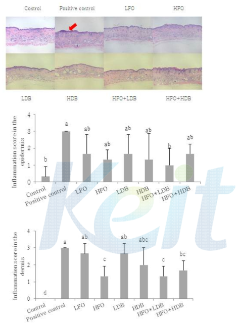 Infiltration of inflammatory cells