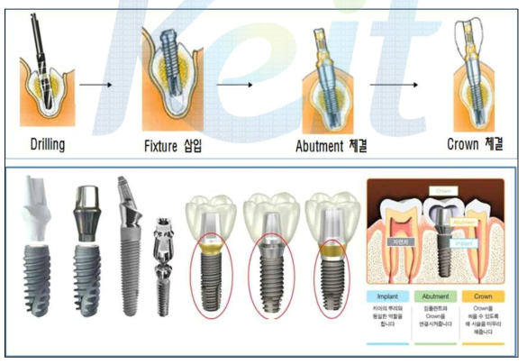 임플란트의 형상 및 시술과정