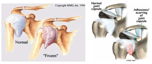 정상 어깨와 유착성 관절낭염에 걸린 어깨의 비교 그림