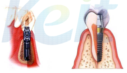 나사형으로 만들어진 치과용 임플란트의 사용을 나타낸 그림. 임플란트가 이식되기 위해서는 일정 높이와 폭을 가진 치조골이 필요함.