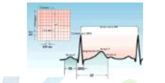 ECG 곡선과 기록지